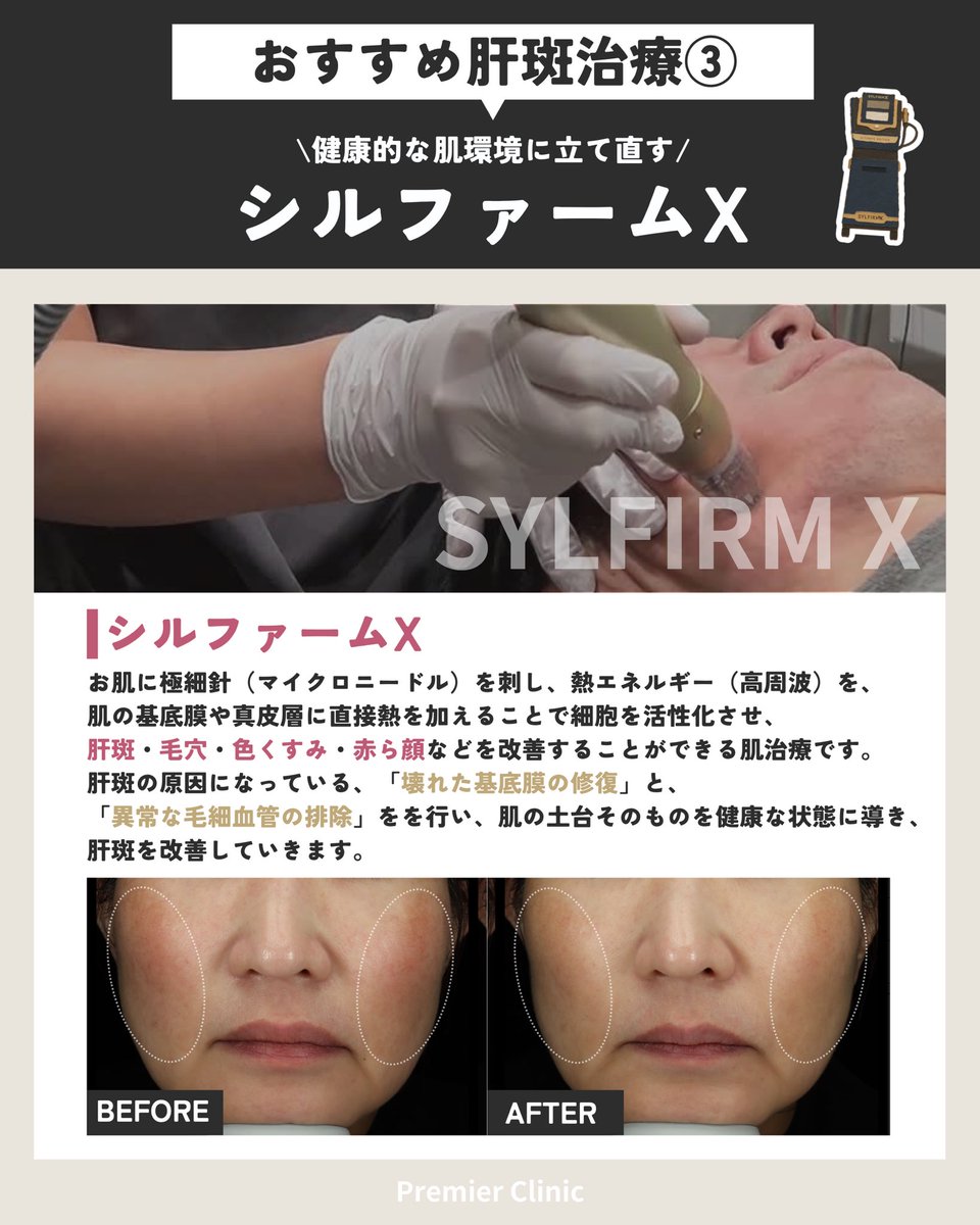 premier1clinic's tweet photo. 広島プルミエクリニック💎
広島県広島市中区本通7-29アイビービル4F

https://t.co/yUJ0d7E4Rp

肝斑治療なら広島プルミエクリニック

#広島プルミエクリニック #美容外科 #美容クリニック #症例写真 #美容皮膚科 #広島美容クリニック #美容治療 https://t.co/Y8IDZ3McYM