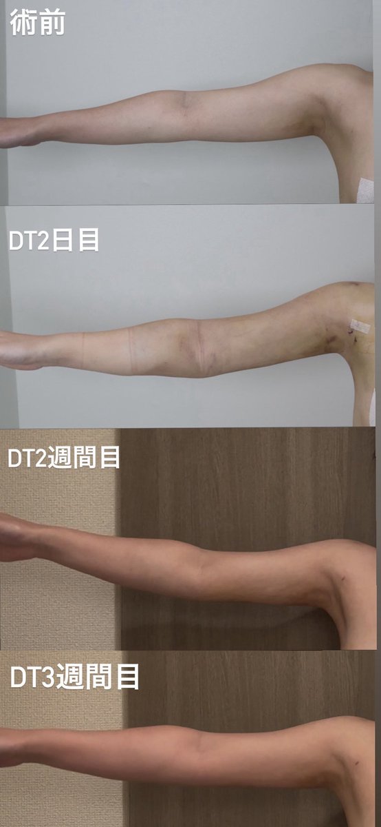 anagoryan's tweet photo. @delight_ps_jp で二の腕と腹部の脂肪吸引をして3週間が経ちました。お腹の拘縮は少しずつ良くなりましたが、満腹の時には張る感じがあり少し辛いです。二の腕はまだバンザイができません。まだ触られた時に違和感や痛みを感じます。
#二の腕脂肪吸引　
#腹部脂肪吸引 https://t.co/3xNTcyGR40