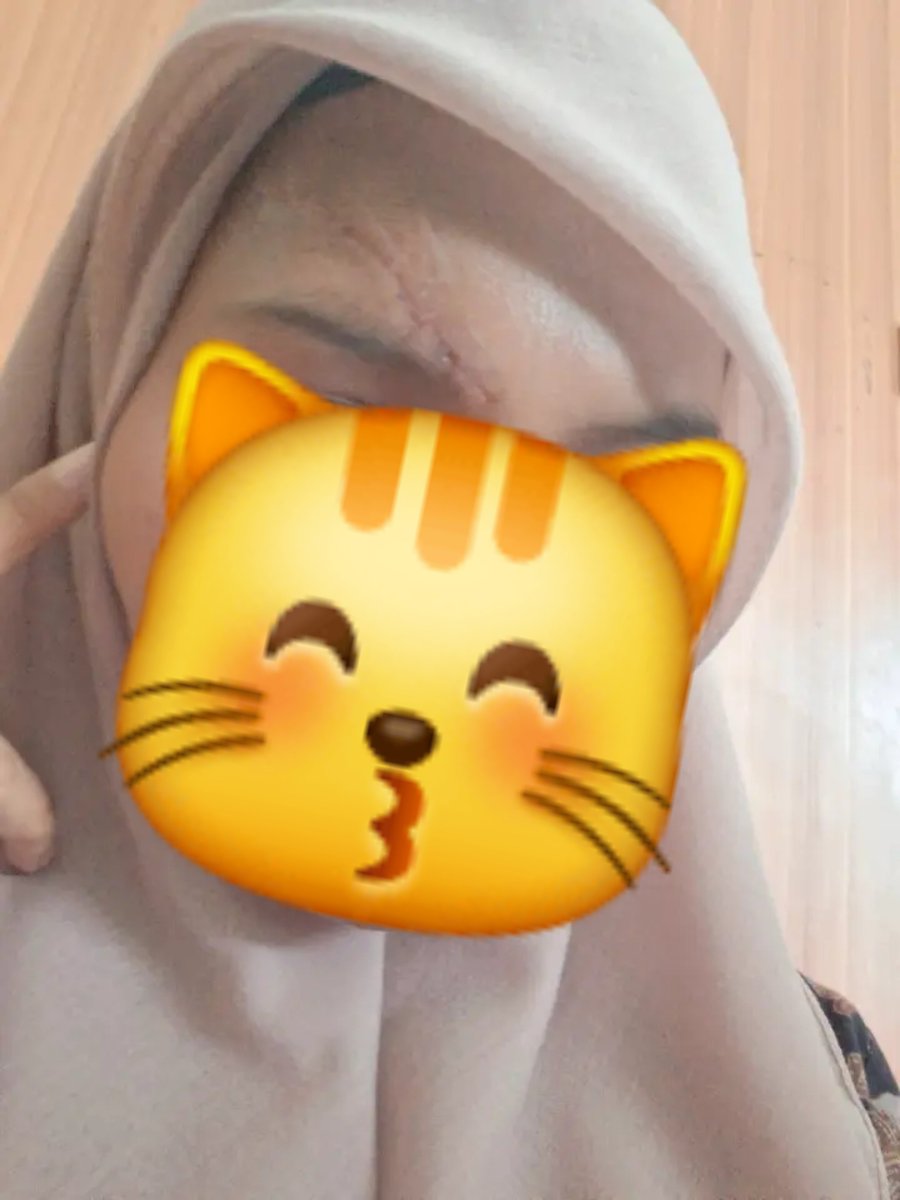 bunnysool's tweet photo. day-1 ke kampus udh gak diperban lagi, mencoba untuk pd dengan polesan wajah baru hhhi😁 https://t.co/4F43K9nm7m