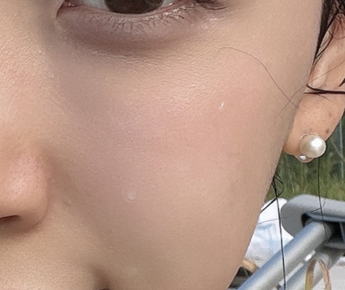 yoonvlovee's tweet photo. 공주들아 다들 주근깨,기미 확실히 없애고싶으면 >루비레이저<해 ㅈㅂ 초등학교때부터 주근깨때매 너무 스트레스라 매일 미백앰플이며 레이저며 최소100만원 이상은 썼는데 약간 옅어졌다가 다시 진해져서 거의 반포기 상태로 살았거든? 근데 나도 추천받고 루비레이저 했는데 90퍼는 아예 사라짐 ... 걍 아예흔적도 없이 사라졌고 2년이 지난 지금도 주근깨라곤 찾아볼수 없는 피부가 됐음 ... 가격은 싸진 않지만 1트에 조지고싶다면 무조건 루비레이저 하자
속 주근깨까지 다 조져줘서 거의 900방쐈고 
내 친구 중 한명은 1000샷 넘게 쐈음.. 
다른 레이저 안됨 무조건 루비!!!!!!!!!💎💎💎
(1트에 조져지는 대신 고통 심함, 딱지 떨어지기전까지 거울보기싫을만큼 못생김 감수)