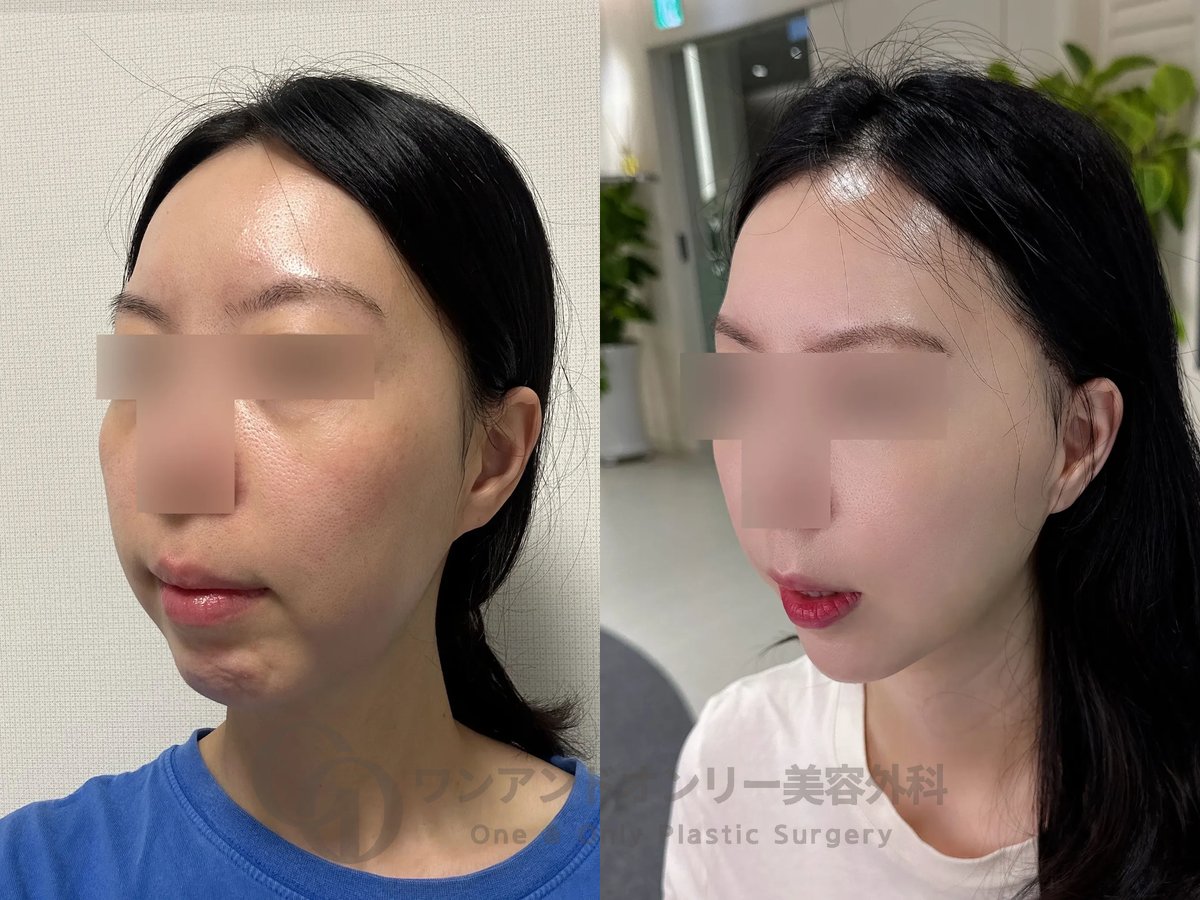 one_only_ps's tweet photo. 骨を削らず顔の軟組織SMAS層を
二層に分離し精密に整え
立体的な輪郭を仕上げる
ワンアンドオンリーのO2軟組織輪郭術❤️

公式LINEへお気軽に
お問い合わせください😊
https://t.co/iqv5q8fGVF

#韓国整形 #美容整形 #整形 #整形垢 #切開リフト #フェイスリフト #たるみ #中顔面 #ミニリフト #輪郭 https://t.co/rqXGbbTFu9