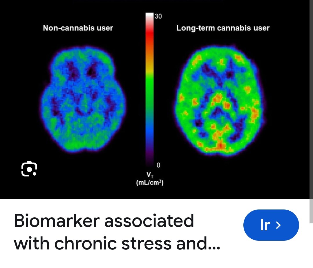DR_AID_AVILA's tweet photo. #HugoAguilar
#Claudiasheibaum
#DavidKrasenovich
#Adelforegino
#Leticiaramirez
Neuroimagenes de uso Cannabis en distintas dependencias... https://t.co/VFqmuWlIgH