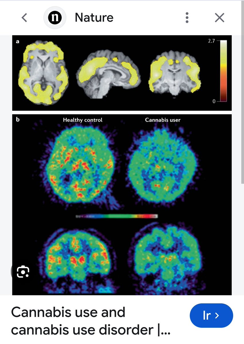 DR_AID_AVILA's tweet photo. #HugoAguilar
#Claudiasheibaum
#DavidKrasenovich
#Adelforegino
#Leticiaramirez
Neuroimagenes de uso Cannabis en distintas dependencias... https://t.co/VFqmuWlIgH