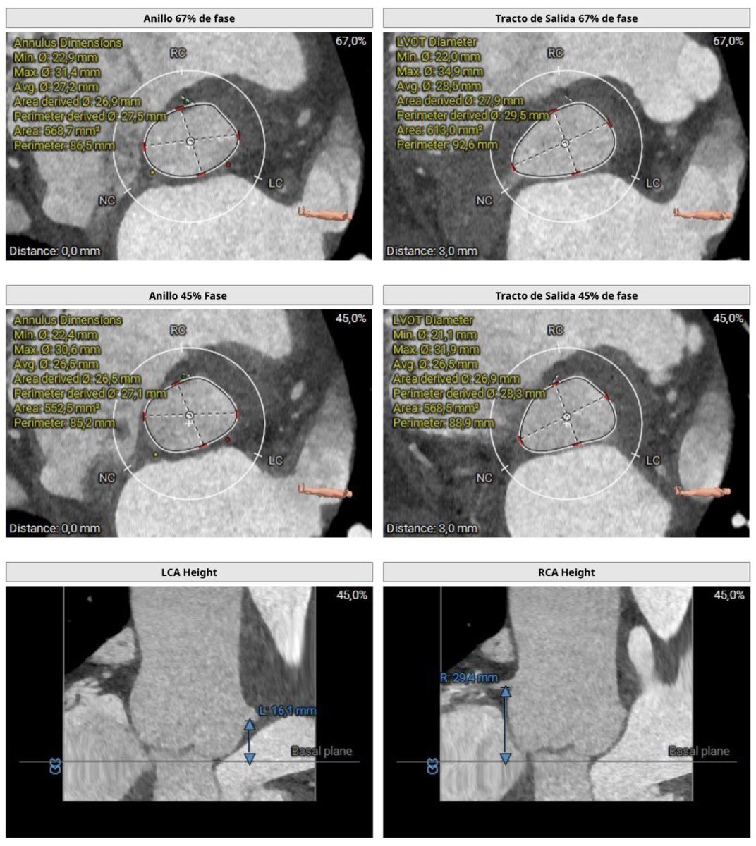 CorazonHuvr's tweet photo. PURE AR day in our cath lab!! Severe pure AR in a patient with severe LV dilation and EF 35%. Aortic annulus 569 mm2 < LVOT 613 mm2, without calcification. Successful Myval 32,5 (-1cc) implantation with excellent final result @pepp183 @Albabfc @Monicaferqu @RosaCP8 https://t.co/p5wyiBD244