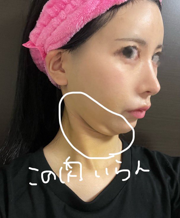 EeK9yq's tweet photo. 有識者教えてください
脂肪吸引等DT7日目で顎引くと顎下の肉普通にあるんですけど経過とともにこれって無くなるものなんですか❓
Xに上がってる整形垢さんの経過みんな直後から顎下ペラい人多いから焦ってる
#整形垢さんと繋がりたい
#整形垢と繋がりたい https://t.co/GJdwAOusQr