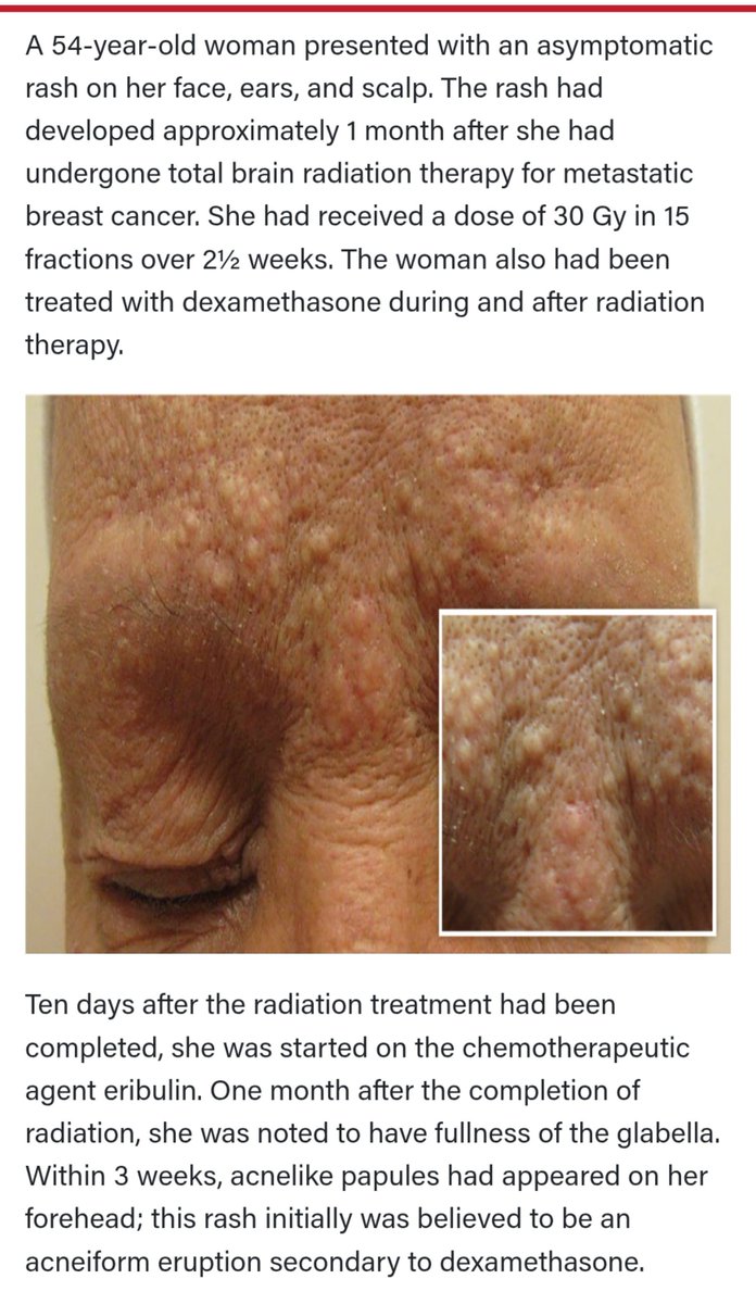 citizenshiper1's tweet photo. @crystalshen6 That seems accurate *Post-radiation Acne-iform Eruption" 🤔⚖️📸 #Acne #HavanaSyndrome #LRAD #FreyEffect @RepLuna @DHS_Wolf @disclosetv ⚖️🔎 https://t.co/gJ2qiLAEdC