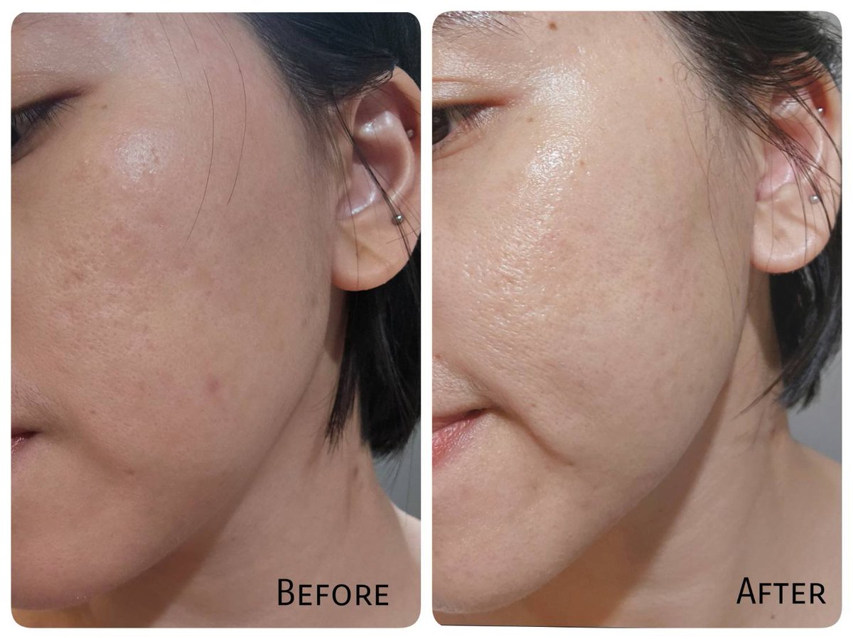 laywithme99's tweet photo. เซรั่มลูกรักของคนเป็นสิว ต้องยกให้​ Eucerin Triple Action ใช้ตั้งเเต่ช่วงที่สิวบุก ช่วยลดการอักเสบทำให้สิวยุบไว​ และเค้ามีสาร ไทอามิดอล ช่วยเคลียร์พวกรอยดำรอยแดงจ���กสิวตัวเนื้อเซรั่มบางเบา​ ซึมไว​ ทาแล้วหน้าไม่หยาแน่นอน 

#EucerinTripleAction #Eucerin #ใช้ดีบอกต่อ https://t.co/wukm256CMY