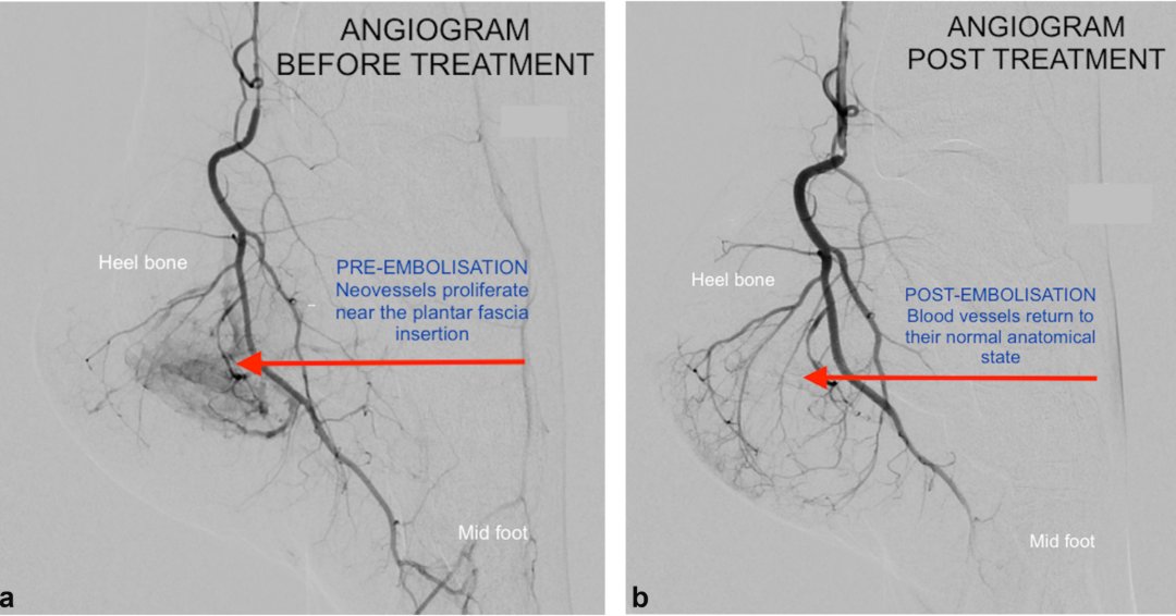 JVIRmedia's tweet photo. 🔎 Inside Access: Can transarterial embolization help treat recalcitrant plantar heel pain? 

Read the open access article and full interview: https://t.co/iDA09qZZUU

#IRad #JVIR #PlantarHeelPain https://t.co/FjqUDQ1KRi