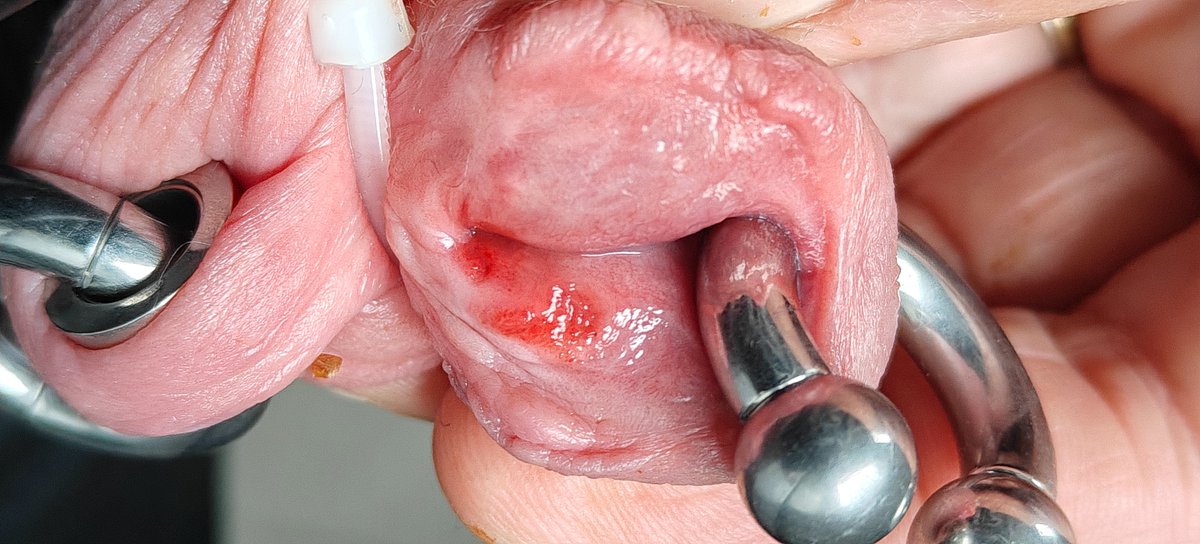 112Pinpon's tweet photo. My transscrotal piercing with a 00g Prince Albert, a 14mm tunnel, and a 00g ring.
#Transcrotal #PrinceAlbert #Piercing #PiercingTunnel https://t.co/BNJMcr2u19