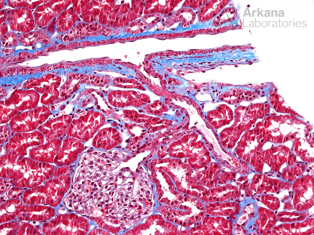 arkanalabs's tweet photo. What is your diagnosis?

#DiagnoseThis #nephtwitter #pathtwitter #renal #kidneypath https://t.co/IBEpuvEYNV