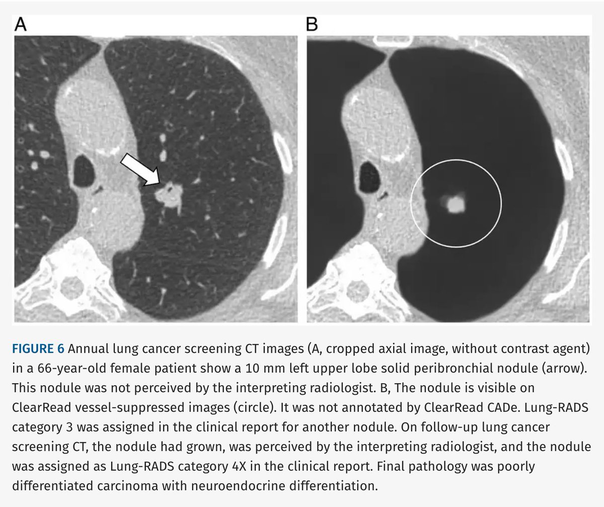 JTIJournal's tweet photo. 🫁 New in JTI: Real-world performance of AI for #LungCancer (LC) detection at screening!

🤖 In 129 patients, 92% of LCs were visible on vessel-suppressed images, with CADe sensitivity of 72%.

👀 Detection varied by nodule type: Solid: 80%; Part-solid: 75%; GGO: 38%; Cystic: 13% https://t.co/epojV7w1M7