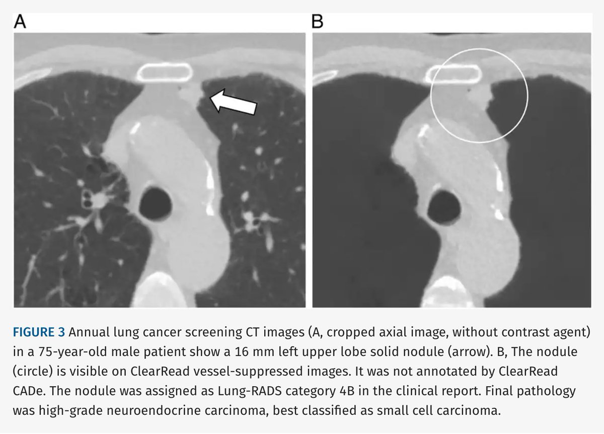 JTIJournal's tweet photo. 🫁 New in JTI: Real-world performance of AI for #LungCancer (LC) detection at screening!

🤖 In 129 patients, 92% of LCs were visible on vessel-suppressed images, with CADe sensitivity of 72%.

👀 Detection varied by nodule type: Solid: 80%; Part-solid: 75%; GGO: 38%; Cystic: 13% https://t.co/epojV7w1M7