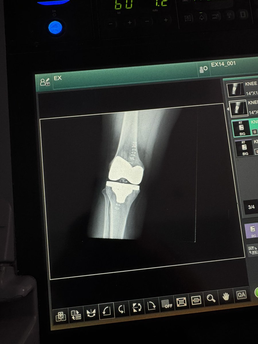 Abd7719's tweet photo. My 1st Total Knee Replacement as primary surgeon 😎 
From A to Z https://t.co/hrCDg0Hkmf