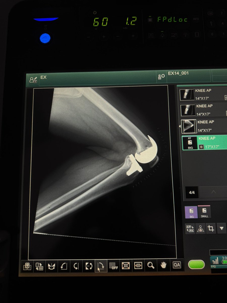 Abd7719's tweet photo. My 1st Total Knee Replacement as primary surgeon 😎 
From A to Z https://t.co/hrCDg0Hkmf