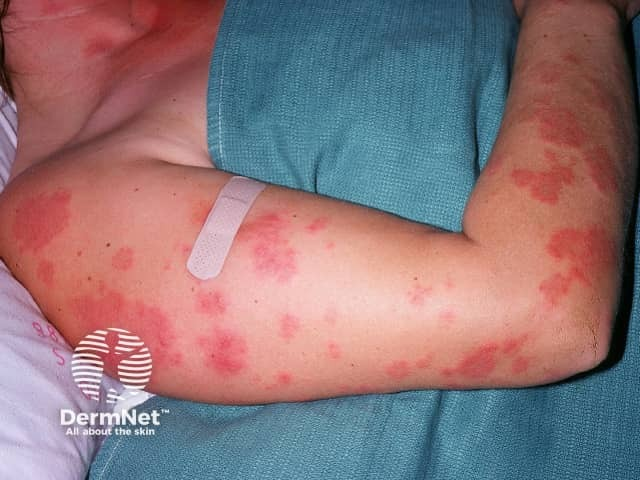 SkinofColorcomm's tweet photo. A patient presents with the following erythematous, annular plaques on the upper extremities. What is the most likely diagnosis?

A. Subacute cutaneous lupus erythematosus
B. Tinea corporis
C. Erythema multiforme
D. Granuloma annulare https://t.co/GaAuqbwSgc