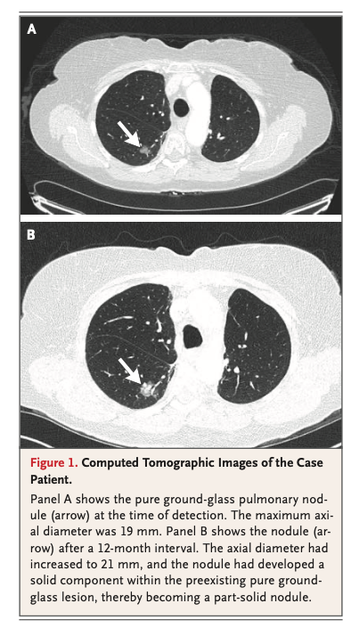 LuisOliverio's tweet photo. Nódulo pulmonar, la última revisión de NEJM (2026). Puntos clave:

🟢 Un nódulo sólido estable a 2 años es benigno y se da de alta (1 año basta si se confirmó por volumetría). Los subsólidos crecen más lento: requieren ≥4 años de estabilidad antes de llamarlos benignos.
🟢 Importante estratificar con un modelo (Brock si es tamizaje o subsólido; Mayo/Herder si es incidental sólido): <10% → vigilancia por CT; 10–70% → PET-CT y/o biopsia; >70% → manejo definitivo, con cirugía posible sin biopsia previa. Umbrales para PET: ≥8 mm o ≥300 mm³ (abajo de eso es inútil)
🟢 Hasta 60% de los subsólidos desaparecen, así que repite CT a 3–6 meses para confirmar persistencia antes de hacer cualquier cosa.
🟢 La biopsia por broncoscopia navegada puede ser tan buena como la transtorácica (rendimiento 74% (aguja transtorácica) vs 79% (broncoscopía navegada), lo malo: neumotórax 28% vs 3%.
🟢 Solo 3–4% de los nódulos detectados son cáncer; pero 50% de los pacientes sufre distrés durante el proceso.