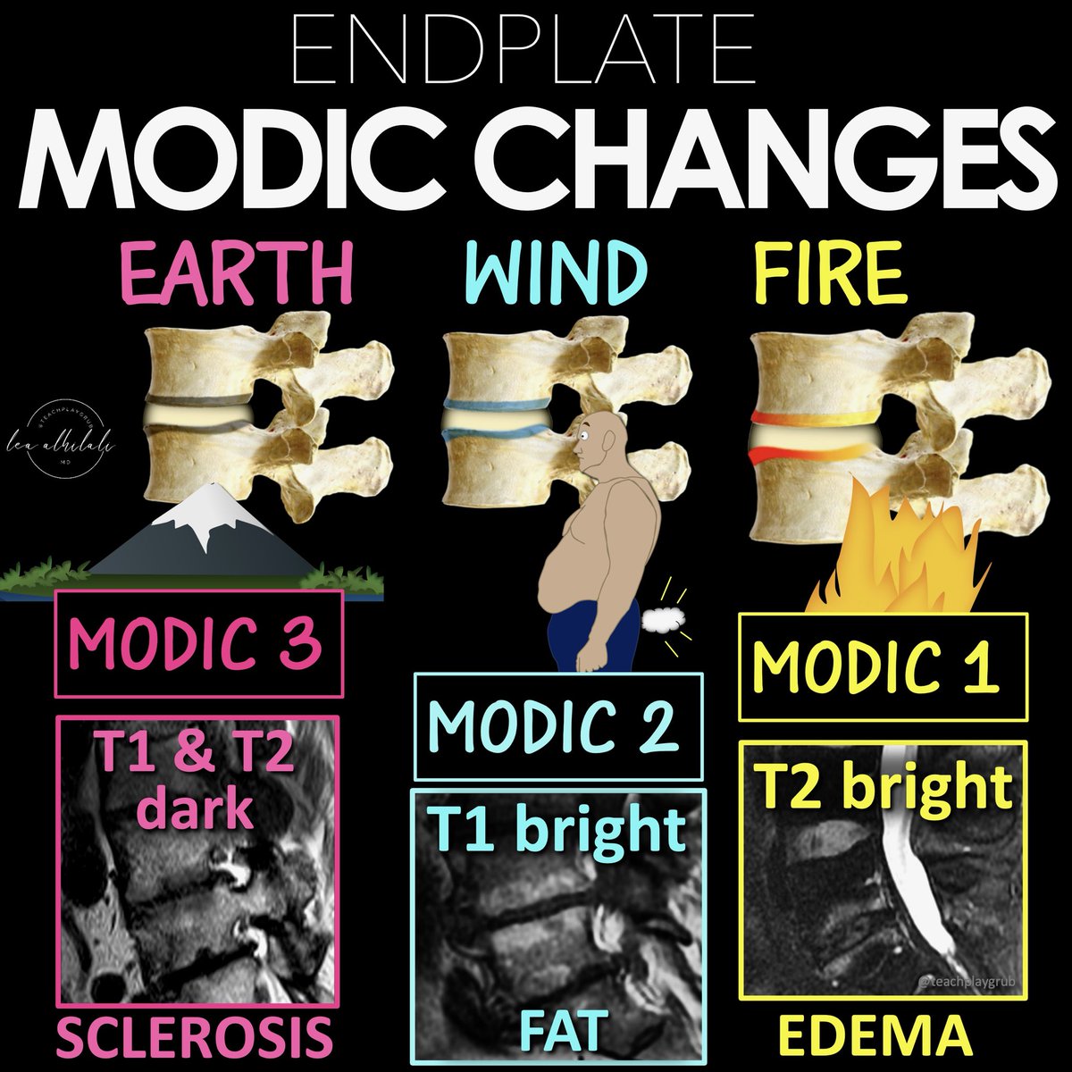teachplaygrub's tweet photo. Do you feel there’s a back-log of findings in a spine MRI report?

Everyone talks about discs & facets, but not everyone talks about the endplates.

Do you?

Do you need to talk about degenerative changes (Modic changes) of the endplates?

Here’s thread w/all you need to know!

Over 30 years ago, Modic et al. found there were 3 types of degenerative endplate changes:

(1) T2 bright changes (indicating edema, Modic 1)
(2) T1 bright changes (indicating fat, Modic 2)
(3) T1 & T2 dark changes (indicating sclerosis, Modic 3)

But what do they mean?

MODIC 1
--Bright on T2, indicating edema.
--Pathology shows inflammation, vascular granulation tissue, & high cellular turnover
--Vascular granulation tissue means these can enhance on post contrast images—mimicking discitis!

MODIC 2
--Bright on T1, indicating fat.
--Show fatty conversion of the marrow & low cellular turnover.
--I think of them as the middle-aged dad bod of degenerative change—lots of fat & slow to change!

MODIC 3
--Dark on T1 & T2, indicating sclerosis
--Pathology showsdense fibrous tissue & sclerosis.
--Like endplates get fossilized—once you turn into rock, you are never going back.

I remember these bc the forces at work in the endplates are like the famous astrology signs—almost.

Earth (sclerosis)
Wind (fatty changes, when you feel fat & full, you tend to give off wind!)
Fire (inflammation, edema)

Now you can use this when you go BACK to work on reading spine MRIs!