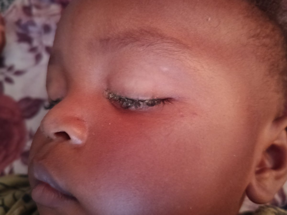 WafaaAman2001's tweet photo. My child urgently needs treatment for their eye, but I cannot afford the medical costs.
🙏 Please don’t ignore my plea. If you can, donate now or repost to help us reach the treatment we desperately need. Every contribution can make a difference. ❤️‍🩹
https://t.co/y0CmxJ3Orp https://t.co/BoCXzdqrxN