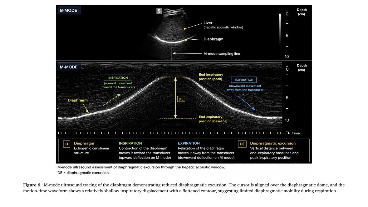 EmergPOCUS's tweet photo. 🫁 Cómo valorar la excursión diafragmática con ultrasonido?

📍 Se utiliza el hígado como ventana acústica para identificar el hemidiafragma derecho.

🫯 En modo M:

• Durante la inspiración, el diafragma se contrae y se desplaza hacia el transductor ⬆️
• Durante la espiración, se relaja y se aleja ⬇️
• La distancia entre la posición al final de la espiración y el pico inspiratorio corresponde a la excursión diafragmática.

⚠️ En esta imagen, el desplazamiento es poco profundo y la curva aparece aplanada: hallazgos compatibles con movilidad diafragmática reducida.

Pero atención… una excursión baja no confirma por sí sola debilidad muscular. Debe interpretarse considerando esfuerzo inspiratorio, posición, soporte ventilatorio y contexto clínico.

#POCUS #Ultrasonido #Diafragma #MedicinaCrítica