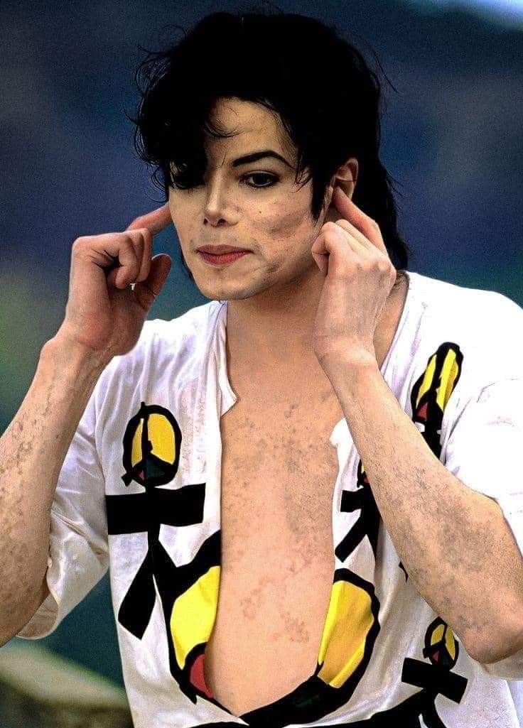 mjculturebrasil's tweet photo. 🚨 INFORMAÇÃO! O vira-lata brasileiro Buddy viralizou ao mostrar a evolução do seu vitiligo, desencadeado pelo estresse emocional após perder a dona.

O caso ajuda a explicar cientificamente o que aconteceu com Michael Jackson, que, segundo alguns observadores, teve a doença agravada drasticamente pelo estresse após o trauma do acidente da Pepsi em 1984. 

A ciência derrubando o sensacionalismo.