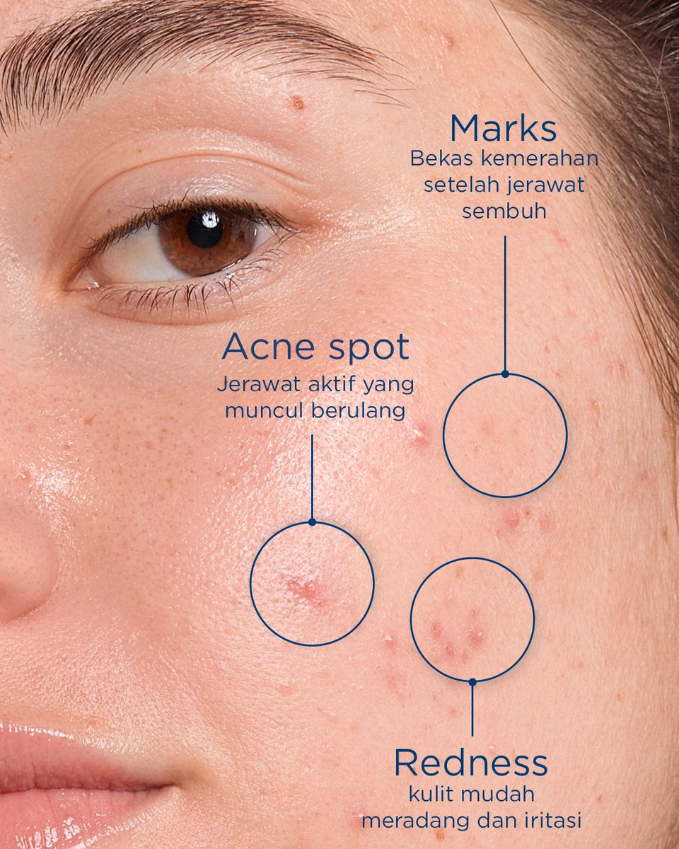 Bioderma_ID's tweet photo. Spots that keep coming back, marks that won't fade, skin that stays red and reactive.These are signs your skin needs more than a spot treatment. It needs a routine that works at the root.The Sébium range is built for exactly that. Cleanse, control, and prevent, all in three steps https://t.co/TpFJjackPf