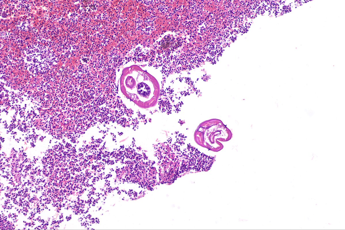 surgpathcases's tweet photo. Appendix
#pathology #patologia #gipath #gipathology https://t.co/YTAa1KxCi2
