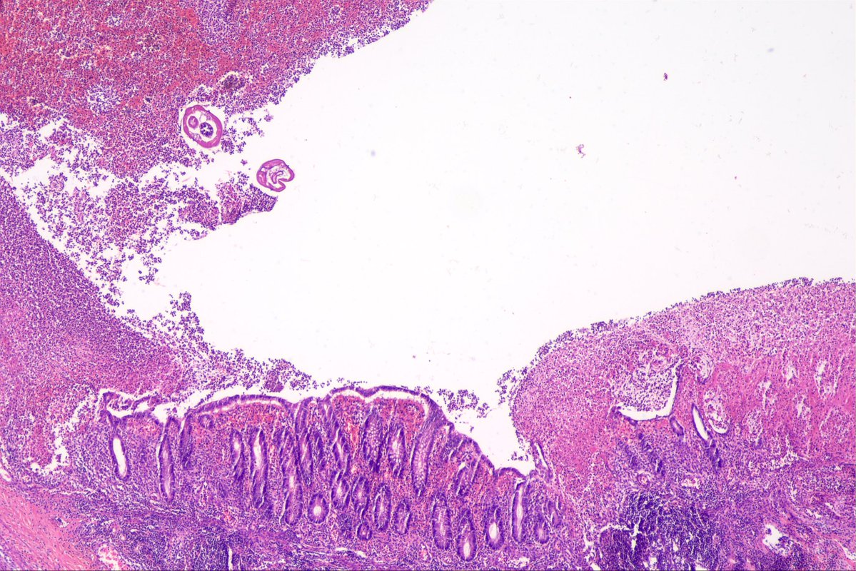 surgpathcases's tweet photo. Appendix
#pathology #patologia #gipath #gipathology https://t.co/YTAa1KxCi2
