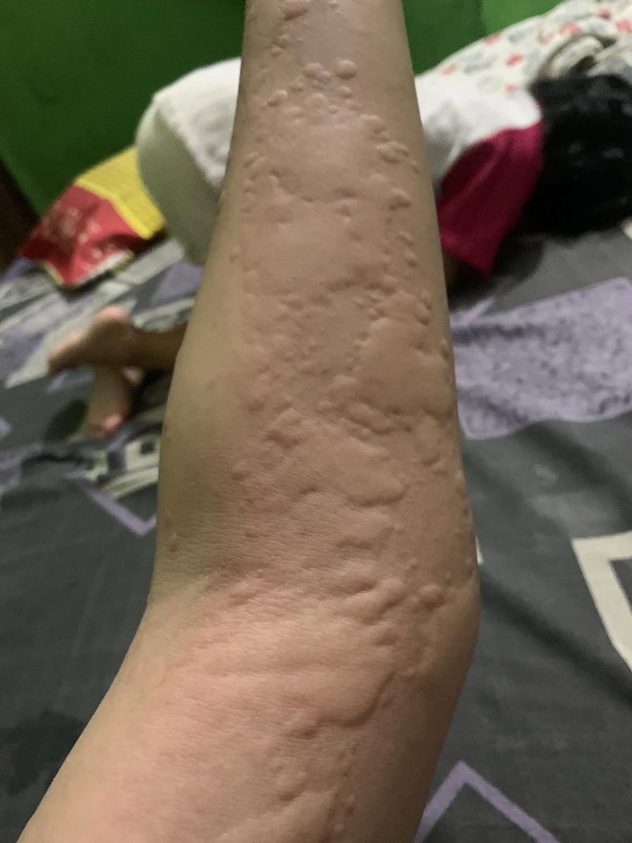 Elmeira_08's tweet photo. AKU PENASARAN BANGET, INI NORMAL GAK SIH? 😭
ada yang pernah ngalamin kulit mendadak bentol-bentol kayak gini? https://t.co/4Il5SVudZP