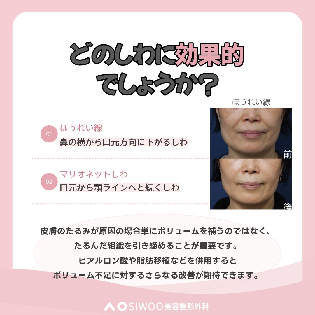 Siwoopsjp's tweet photo. リフトアップが気になる方へ✨
糸リフトの施術方法や期待できる効果、施術後の注意点までまとめました。
ぜひ参考にしてみてください🤍

お問い合わせ
📩https://t.co/Rp0zJpGxir

#糸リフト #リフティング #整形情報 #韓国整形 https://t.co/KkL469rWdA