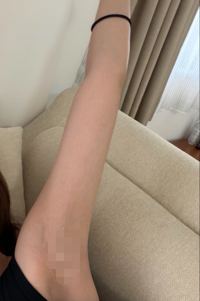 _____xxkrm's tweet photo. これめちゃ分かる、わしは1秒でも細くなりたかったからやった🤣
脂肪吸引から3年経過したけどボコ付き色ムラ弛みなく傷跡も綺麗にしてくれて執刀医には大感謝。ｶﾞﾁ職人の先生だから激安系ではないけど良心的な金額でアップセルもないし信頼してるクリニック。いつか脂肪豊胸もここでやる予定 https://t.co/8ZgQ2lq3Yk