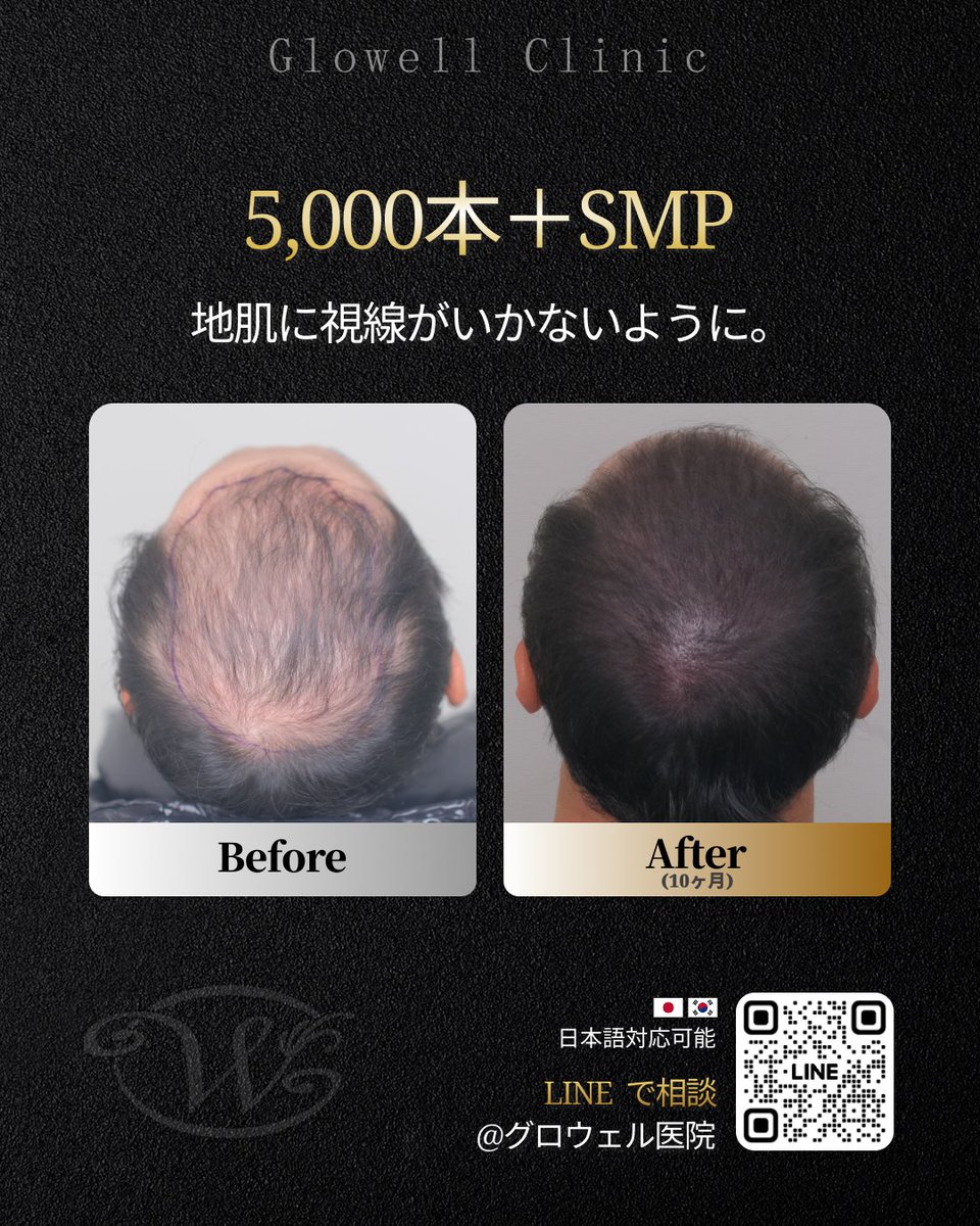 gwl26319900's tweet photo. 頭皮だけ、なんだか目立って見えていませんか？👀
5,000本植毛＋SMPで、
広い頭頂部をひとつのシルエットに !

“薄毛が目立つ”から
“ヘアスタイルが目にいく”

📍韓国・汝矣島 グロウェル医院
🌐日本語対応可能
https://t.co/9ZSIWhybJ8

#韓国植毛 #頭頂部薄毛 #SMP https://t.co/4DkyGD9jTm