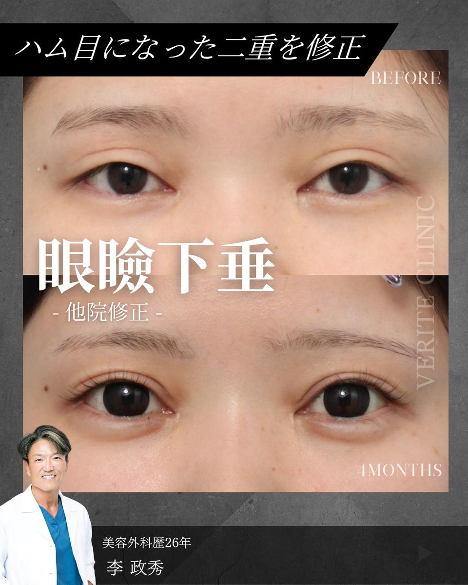 drlee_verite's tweet photo. 他院で目力アップ目的で眼瞼下垂手術を受けられたそうですが、思ったような変化が無かったどころかハム目になってしまったと修正のご相談にいらっしゃいました
ハム目の原因は無理な幅で二重を作った事、眼瞼下垂手術でこの幅広の二重をしっかり折り返すレベルの目力が得られていない事が考えられます https://t.co/KNHiSwfeTl