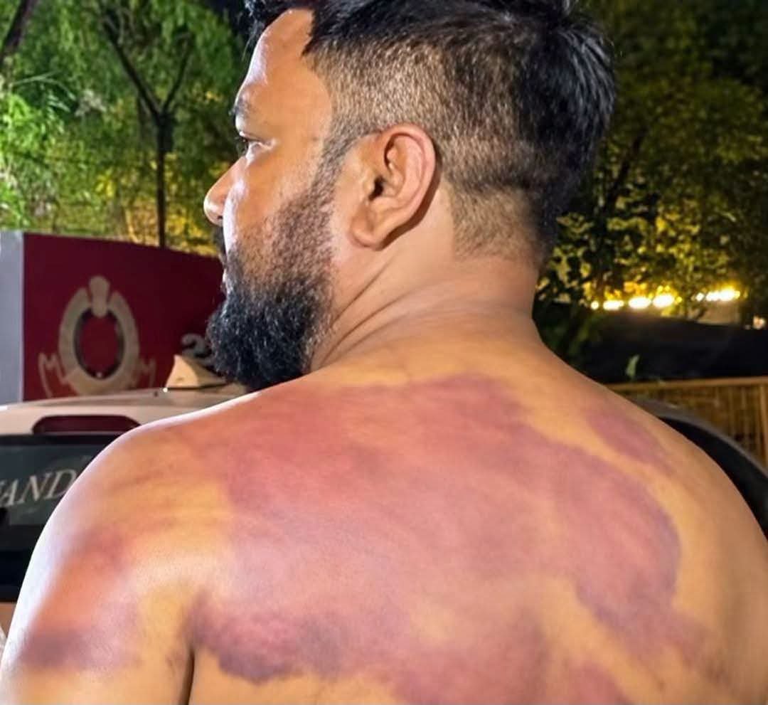 SonOfBharat7's tweet photo. आ गया स्वाद... BSD के 🖐️

कह रहा था 
“चप्पल पहनों बाटा की छोरी यूज करो जाटां की” 

अब किसी ने पकड़कर भूत बना दिया और 
बताया जा रहा है चप्पलें बाटा की ही बरती गयी है

जिस तरह सभ्य समाज के लोग किसी भी प्रकार की हिंसा का समर्थन नहीं करते ठीक उसी तरह सभ्य समाज में समाज के सभी तबकों की बहन-बेटियां साझी प्रतिष्ठा होती हैं।

बिनोद साहनी हो या वो बिहार वाला कार्टून कुशवाहा हो सबकी सुताई केवल इसलिए हुई क्योंकि वो सामान्य वर्ग से संबंधित समाजों की बेटियों पर घृणात्मक अश्लील टिप्पणियां कर रहे थे जिसमें बिनोद जी तो निकल लिए।

फोटो और भी डिटेल्ड हैं जिसमें 
इनके पिछवाड़े का भीमांड बना दिया गया है...

लेकिन भीम एक्ट का सम्मान रखते हुए नहीं डाल रहे हैं

वैसे फोटो वाला व्यक्ति और जिसने इसका
 इलाज किया है दोनों एक ही पार्टी के लोग हैं, 
फोटो में दिख रहे व्यक्ति का नाम है ‘सुनील वाल्मीकि’

इसलिए बस इतना कहूंगा भीमलांडूओं 
बेटी किसी की भी हो... सम्मान करना सीखो🖐️