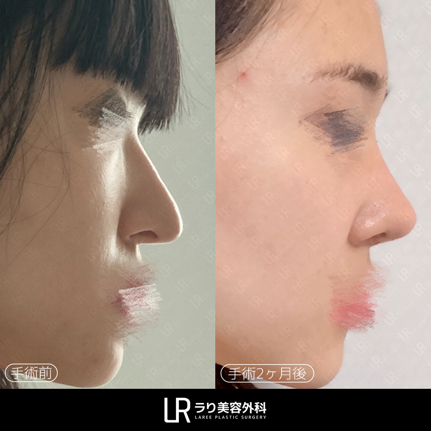 lareeclinic's tweet photo. ✔️鼻の再手術 2ヶ月後  
シリコン入れ替え＋矢印鼻矯正＋ハンプ切除・骨切り

鼻の長さ・鼻先の位置・全体のバランスを考慮し、
自然な鼻の形へ整えます。

LAREE キム・ジョンイル代表院長が
直接診療します。 https://t.co/bseo86xFba