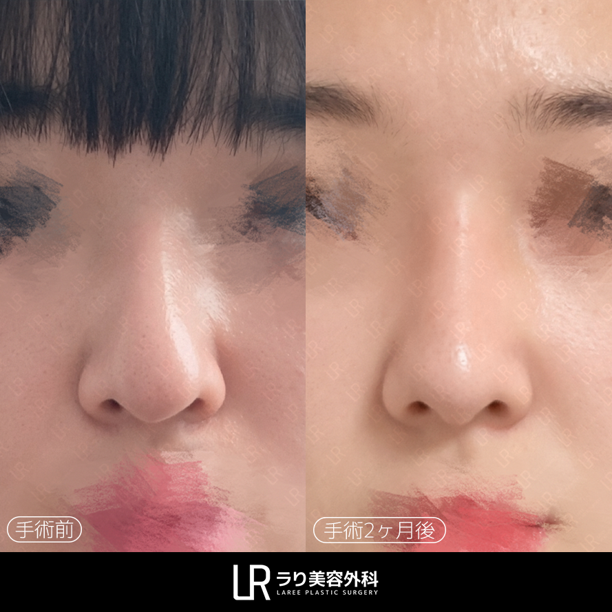 lareeclinic's tweet photo. ✔️鼻の再手術 2ヶ月後  
シリコン入れ替え＋矢印鼻矯正＋ハンプ切除・骨切り

鼻の長さ・鼻先の位置・全体のバランスを考慮し、
自然な鼻の形へ整えます。

LAREE キム・ジョンイル代表院長が
直接診療します。 https://t.co/bseo86xFba