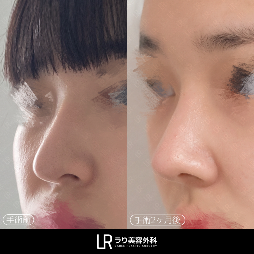 lareeclinic's tweet photo. ✔️鼻の再手術 2ヶ月後  
シリコン入れ替え＋矢印鼻矯正＋ハンプ切除・骨切り

鼻の長さ・鼻先の位置・全体のバランスを考慮し、
自然な鼻の形へ整えます。

LAREE キム・ジョンイル代表院長が
直接診療します。 https://t.co/bseo86xFba