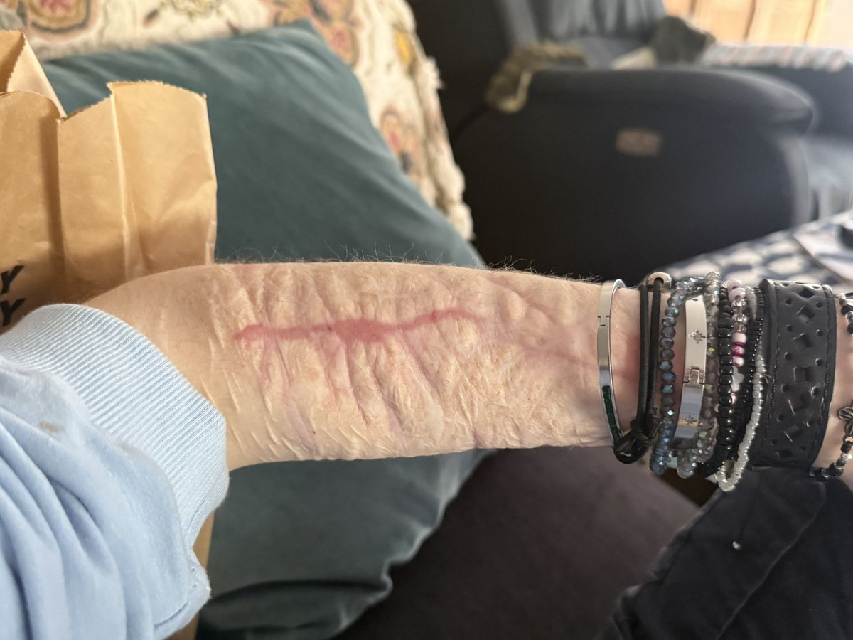 bzz73orb's tweet photo. scars https://t.co/HITYiRICOd