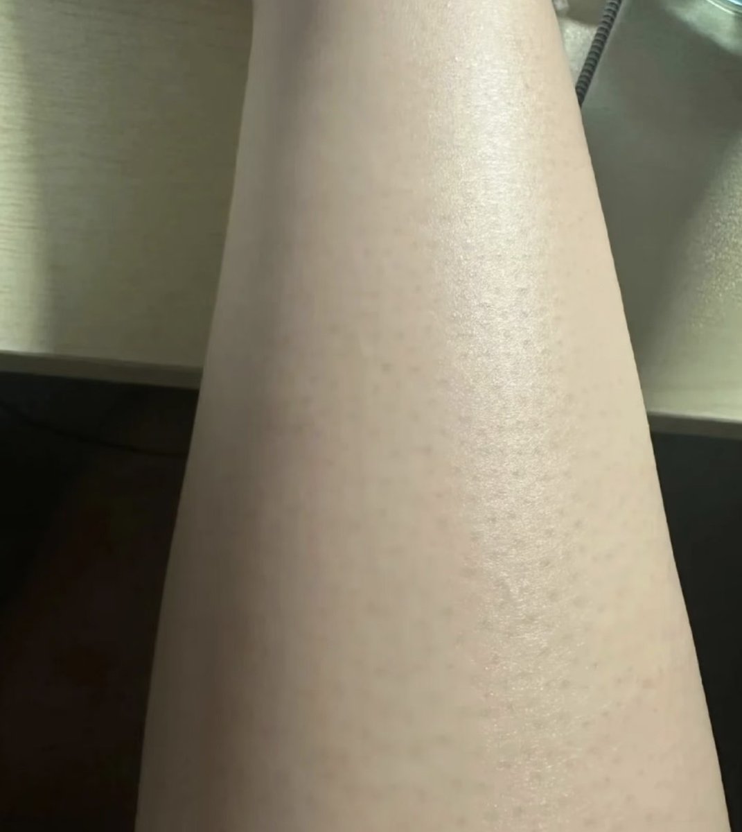 gn15__'s tweet photo. 毛孔性角化症(チキンスキン)は
とにかく毛穴を傷つけない！角質つまらせない！ターンオーバー促進です！！

・毛の処理は除毛クリーム（剃刀×）
↓
・尿素クリーム塗る
↓
・ボディースクラブで角質ケア
↓
・レチノールのボディクリーム

を続けたら3カ月くらいでこんなにツルツルになった🙆‍♀️◎ https://t.co/FeT3Jk6K0O