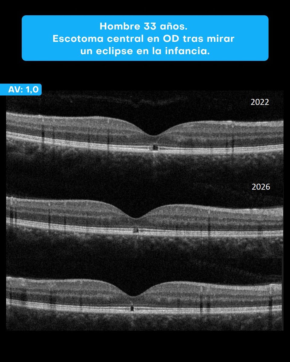RetinaSERV's tweet photo. Cuidado con el eclipse.

Varón de 33 años que acude a consulta refiriendo que, en la infancia, miró un eclipse y desde entonces nota un pequeño escotoma central en el ojo derecho al mirar de frente. Además, refiere percibir la tonalidad de los colores de forma distinta. https://t.co/QY0a468enm