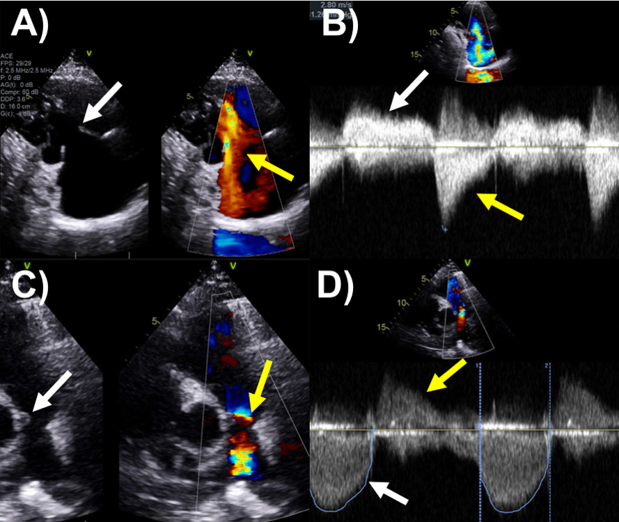 hsfeditor's tweet photo. 🫀 A tumor outside the heart can damage the heart valves.

Carcinoid heart disease develops when bioactive substances from neuroendocrine tumors cause cardiac valve fibrosis.
is essential for improving patient care.
#Cardiology #ValvularHeartDisease #CardioOncology https://t.co/CBVLaJtgfv