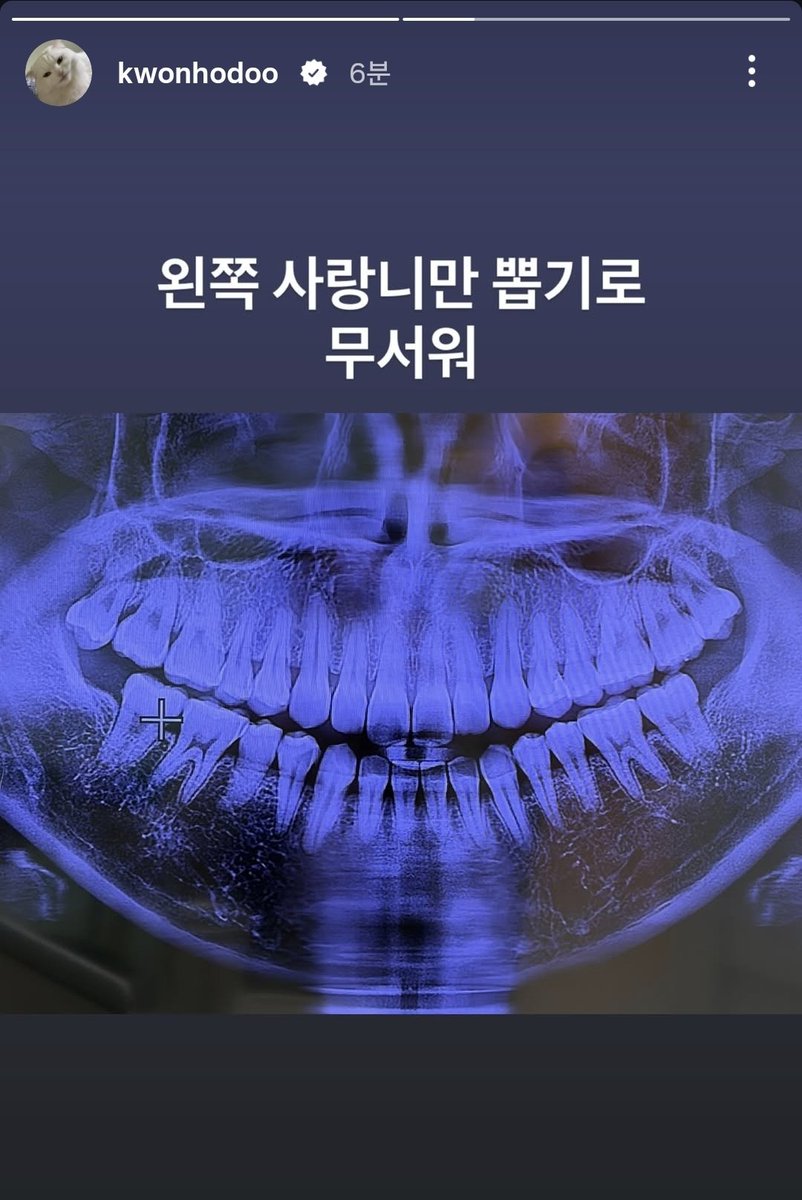 only_kwonjinah's tweet photo. 디나야... 언니도 4개인데 위에 두개는 뼈에 붙어 있다고 하고 아래 두개는 매복이래서 너무너무 무서워서 울면서 왼쪽 아래만 뺐단다.... 사랑니가 한개도 없는 친구가 놀린다고 첫사랑니를 그렇게 옆에서 부르더라ㅋㅋㅋ 사랑니 빼고 다음날 알곱창 먹었더니 회복이 빨랐음 https://t.co/mz8VykLXCk