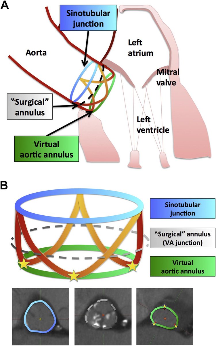 TrackYourHeart's tweet photo. Understanding the anatomy of the aortic root is essential for echocardiography, aortic valve surgery, and transcatheter aortic valve replacement (TAVR).

The aortic root contains three important circular rings:

Sinotubular junction
- The upper boundary of the aortic root where the sinuses become the ascending aorta

Surgical annulus
- Also called the anatomic ventriculo-arterial junction
- The structure where surgeons anchor a surgical prosthetic valve

Virtual aortic annulus
- An imaginary ring formed by connecting the lowest points (nadirs) of the three aortic valve cusps
- This is the key measurement used for TAVR valve sizing