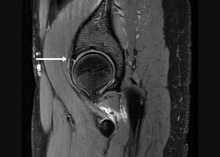 leslievidalmd's tweet photo. What causes a #hip #labrumtear? The #hiplabrum helps stabilize the joint, but it can be damaged by sudden twisting or pivoting, repetitive stress, femoroacetabular impingement (#FAI), or age-related wear. Learn more ➡️ https://t.co/i3U9dIzoDI #hippain #hipinjury #orthotwitter https://t.co/1JWxFD3BDZ