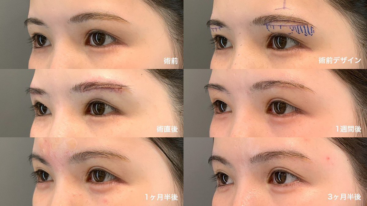 etopclinic's tweet photo. - - - - - - - - - - - 𖤘 - - - - - - - - - - - - -
眉下リフト(眉下切開)+眉骨削りの症例写真
- - -  - - - - - - - - - - - - - - - - - - - - - - -

眉下切開を考えている方
そのかぶさりは皮膚だけが原因ですか？

眉下切開で取れるのは「皮膚」
でも、目元を暗くしている原因が
眉骨やおでこの出っ張りの影の可能性があります🤔

凹凸を整えると
光が入り、目は自然にくっきりします✨