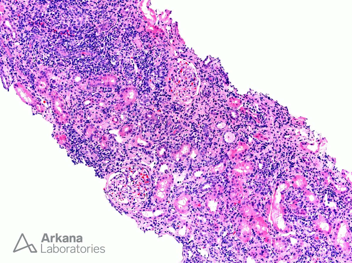 arkanalabs's tweet photo. Chronic interstitial nephritis is a diagnosis made on renal biopsy when interstitial inflammation is present in a background of fibrosis (as depicted here). The differential diagnosis is broad but consists primarily of autoimmune-related and drug-induced etiologies. As opposed to acute interstitial nephritis, which is of relatively recent onset, chronic interstitial nephritis results from a long-standing inflammatory process. The distinction between these two morphologic patterns is made based on the appearance of the background interstitium. If the inflammation is located in areas of fibrosis, as is seen in this case of CIN due to Sjögren’s syndrome, the process is designated CIN whereas if the background is edematous it is designated AIN. The composition of the interstitial inflammatory infiltrate can be identical in both AIN and CIN. Specifically, the inflammatory cells in AIN can be primarily mononuclear (lymphocytes and plasma cells) and the inflammatory cells comprising the infiltrate in CIN can be mixed and even include numerous eosinophils. 

#TeachingPoints #kidneypath #renal #pathology