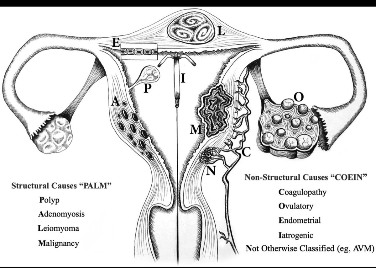 AJOG_thegray's tweet photo. AJOG Giants in Obstetrics and Gynecology: Hilary O.D. Critchley: a physician-scientist who transformed the understanding of menstruation - The PALM-COEIN classification for abnormal uterine bleeding in the reproductive years https://t.co/prn0VSFTJr https://t.co/MEUBtYnX9P