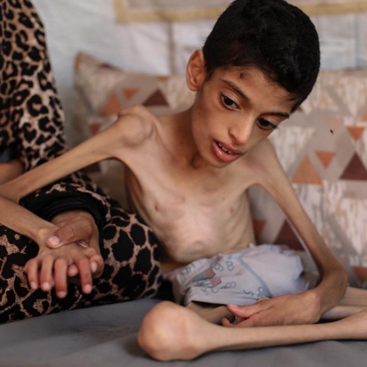 gztcom's tweet photo. 🔴 Gazze'de dramatik tablo: 16 yaşındaki İbrahim, hastalık ve yetersiz beslenmeyle mücadele ediyor

📌 İsrail'in saldırıları ve ablukası altındaki Gazze Şeridi'nin orta kesimindeki Nusayrat Mülteci Kampı'nda yaşayan 16 yaşındaki İbrahim Ebu Seraya, ağır serebral palsi hastası

📌 Genç çocuk, beyindeki elektriksel aktivite artışı ve bölgedeki krizin derinleştirdiği ciddi yetersiz beslenmeyle yaşam mücadelesi veriyor