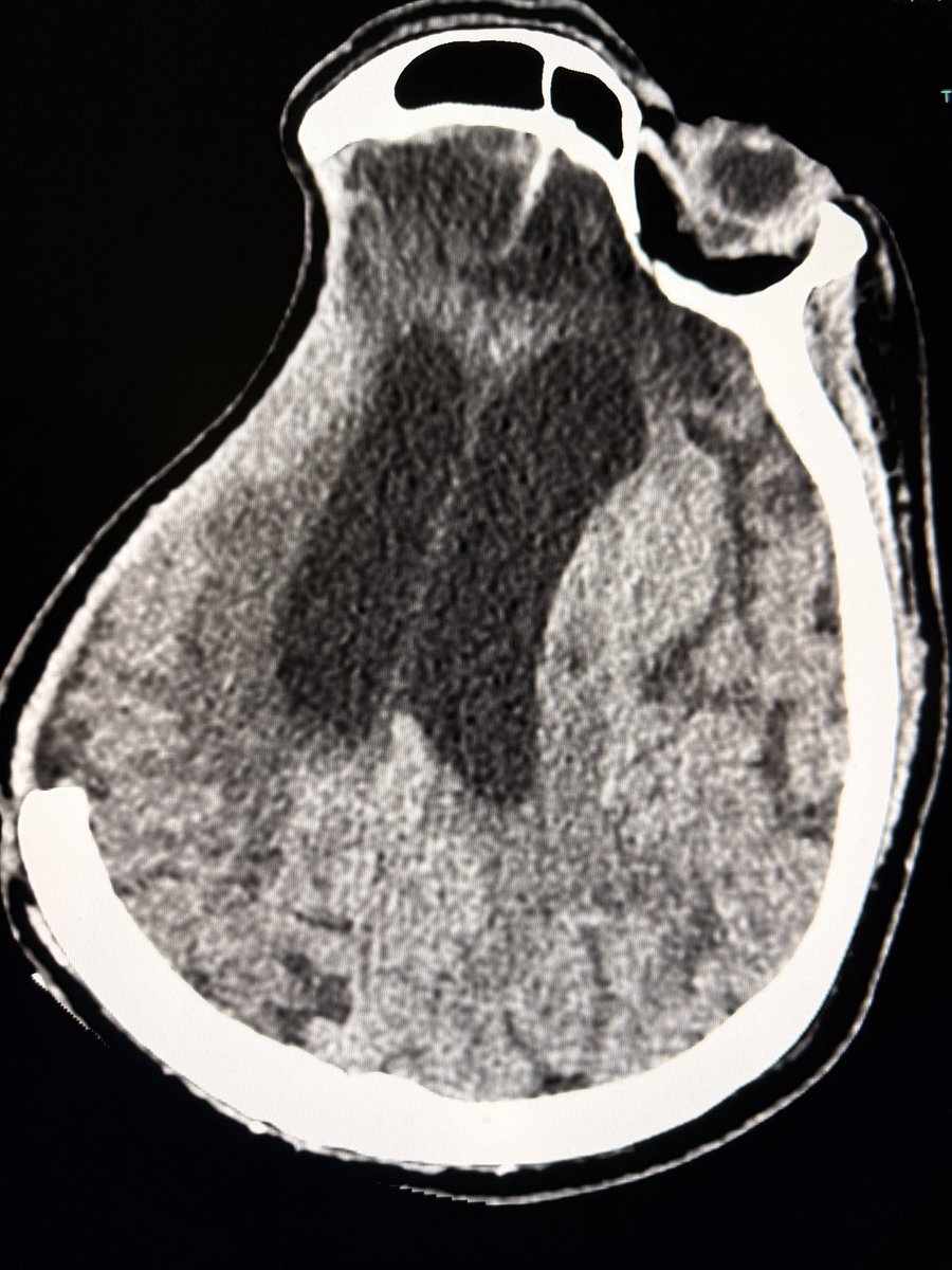 samrad77's tweet photo. Previous decompressive craniectomy, now with a markedly sunken scalp flap and inward deformation of the underlying brain.

One useful reporting point:

A sunken flap is an imaging finding. Sinking skin flap syndrome, or syndrome of the trephined, is a clinical-radiological diagnosis.

So if the clinical deterioration is not known, avoid diagnosing the syndrome from CT alone.

Describe what you actually see:

• sunken scalp flap
• inward deformation of the underlying brain
• midline shift
• ventricular changes
• paradoxical herniation, if present

The syndrome is considered when these findings are associated with neurological symptoms such as headache, weakness, cognitive slowing, gait disturbance, reduced consciousness, or failure to progress neurologically.

Cranioplasty may improve symptoms by restoring more normal pressure relationships, CSF dynamics and cerebral perfusion.

A useful distinction for trainees: 

Report the morphology on imaging. Call it a syndrome only when the clinical picture supports it.

—Pearls, pitfalls and tips from my reporting list