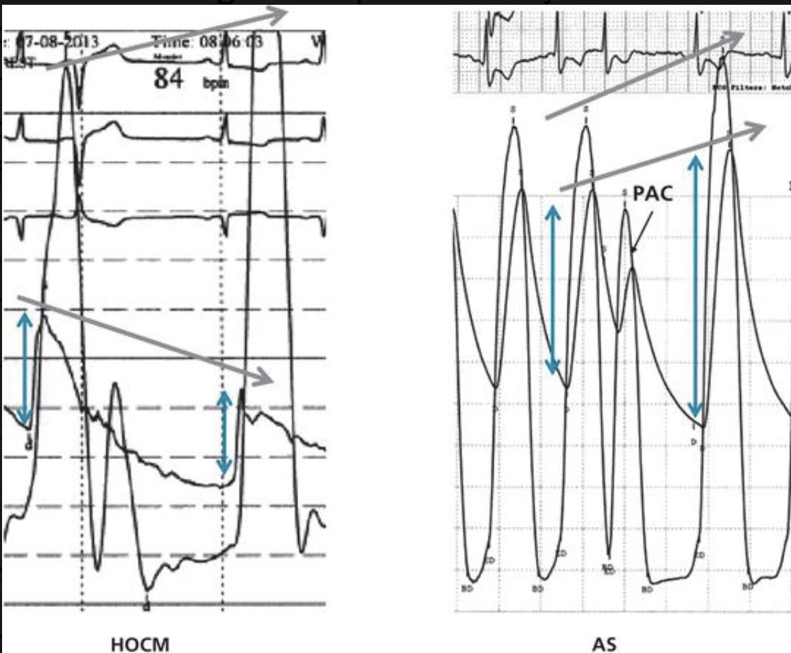 eodanielmd's tweet photo. 🫀 The Brockenbrough–Braunwald���Morrow sign — a hallmark of dynamic LVOT obstruction in HOCM
- Noted after a premature beat

- See previous tweet on post-extrasystolic potentiation (PESP) https://t.co/LZ9O3e49Yi