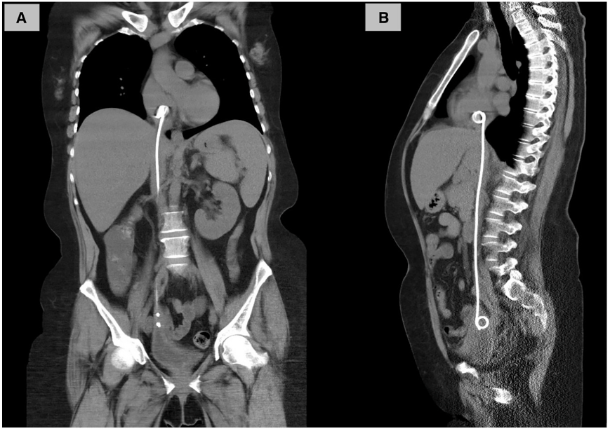 LKrankerMD's tweet photo. Transfer center call: Patient presented with E. coli bacteremia and was found to have a ureteral stent extending from her bladder through the IVC directly into her Right Atrium. What would you do? https://t.co/mbtNMIXPAH